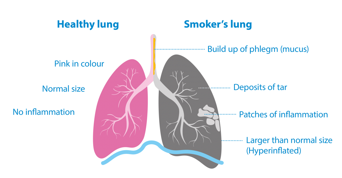 Why is smoking bad for you? The effects of smoking Asthma + Lung UK